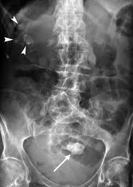 Case 205 Renal Stone Ileus Radiology