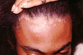 One of the main seborrheic dermatitis causes involves a yeast (fungal infection species) called malassezia. Seborrheic Dermatitis Symptoms Treatment Causes Risk Factors