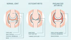 Rheumatoid Arthritis Joint Pain Vs Osteoarthritis Joint