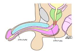 Ureteral Strictures Narrowing