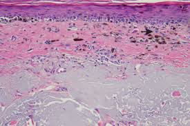 Similar findings after severe radiation exposure. Lentigo Maligna Melanoma Sciencedirect