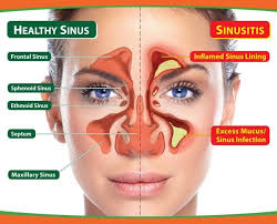 Chronic Sinusitis And Acute Sinusitis Have Similar Signs And Symptoms But Acut Home Remedies For Sinus Sinus Infection Remedies Cure Sinus Infection Naturally