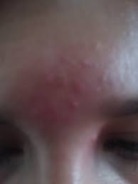 Granitos Pequenos En La Frente Resuelto