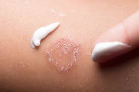 Regardless of studies, us manufacturers are forbidden from marketing their hand sanitizing products with kill claims. Ringworm A Common Skin Condition You Can Treat At Home Orlando Health Arnold Palmer Hospital For Children