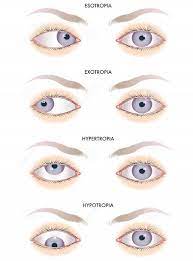 Buatlah vidio sekreatif mungkin 2. Juling Juling Adalah Keadaan Di Mata By Optometrist Facebook