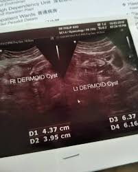 Okey jom kita bincang apa itu cyst. Kesan Cyst Dalam Ovari Pentingnya Melakukan Checkup Tahunan Theasianparent Malaysia