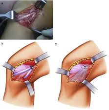 Find out how people damage their mcls and how the injury is treated. Treatment Of Mcl Injury In Combined Acl Mcl Injury Springerlink