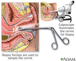 The 2014 review of the system incorporated minimal changes to the earlier version but refined some positions and content. Colposcopy Directed Biopsy Information Mount Sinai New York