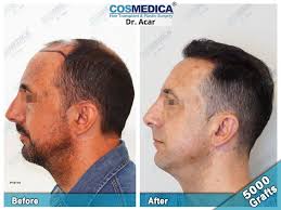 As with the rest of the hair on your head, the transplanted follicles remain in the growth stage for anywhere between 2 to 6 years. Usb19ksyf16sxm