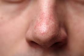 Ivermectin is approved by the us food and drug administration, and used. Rosacea Im Gesicht Tipps Infos Volksversand Versandapotheke