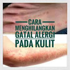 Untuk mengetahui lebih dalam lagi mengenai cara menghilangkan rasa gatal pada umbi talas bisa diterangkan sebagai berikut, bahwa rasa begitulah sedikit tips cara menghilangkan rasa gatal pada umbi talas, semoga bermanfaat. Cara Menghilangkan Gatal Alergi Pada Kulit Anda Pasti Tak Meyesal Notacantik
