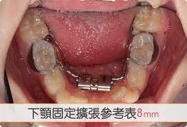 下顎固定式擴張器進度參考表8mm – 兒童牙科黃渝聖醫師