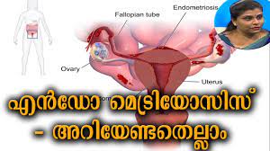 A condition in which cells from the lining of the uterus grow outside the uterus: Dr Q à´Žàµ»à´¡ à´® à´Ÿ à´° à´¯ à´¸ à´¸ à´…à´± à´¯ à´£ à´Ÿà´¤ à´² à´² Endometriosis 24th January 2019 Youtube