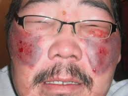 Image result for Frostbite