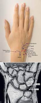Dabei stellt der arzt der der trianguläre fibrokartilaginäre komplex (engl.: Untersuchung Und Mr Morphologie Des Ulnokarpalen Handgelenkschmerzes Pdf Kostenfreier Download