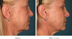 How much does ultherapy cost? Ultherapy Cost It S All The Rage But How Much Does It Cost