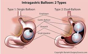 Pin On Bariatric Surgery