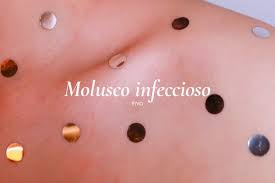 Molusco contagioso: causas, síntomas y tratamiento