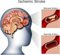 Perinatal stroke is a leading cause of cerebral palsy and may also cause other complications and symptoms. Automatic Detection Of Ischemic Stroke Using Higher Order Spectra Features In Brain Mri Images Sciencedirect
