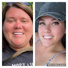 Bariatric surgery weight loss and meal variety