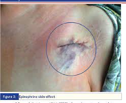 Renal artery thrombosis, transection or dissection (see article: Pdf Arguments To Apply Epinephrine For Pocket Hematoma Reduction The Maitre Study Semantic Scholar