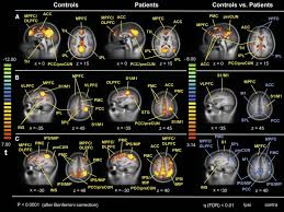Altered Resting State Functional Connectivity In Complex Regional Pain Syndrome The Journal Of Pain
