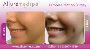 Get Natural Looking Dimples By Dimple Creation Surgery We Safe And Affordable Dimple Surgery In Mumbai India