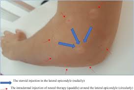 Image result for Epicondyle Injection