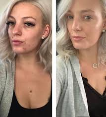 just wanted to share a small success story, in the first photo May 2019. I  was covered head to toe in pso, constantly using steroid creams, trying all  kinds of crazy diets