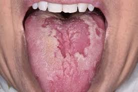 Sore Or White Tongue Nhs Nhs sore or white tongue nhs nhs