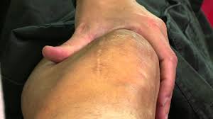 Image result for Knee Bulge Sign