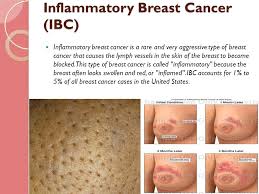 Inflammatory breast cancer is often misdiagnosed because it is so rare, and is difficult to treat because it is particularly aggressive. By Saad Almasoud Lamya Alomair Amir Shams Ppt Download
