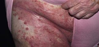 If skin breakdown occurs, the rash may weep fluid and become infected. Candidiasis Of Large Skin Folds Candidal Intertrigo Clinical Gate