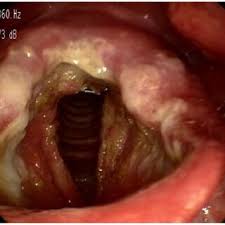 Image result for Chronic Laryngitis