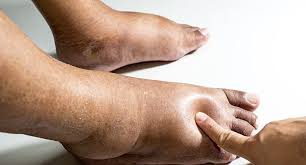 Penyebabnya adalah kelelahan dan belum dikasih pakan, serta kekurangan nutrisi (vitamin b1). Apakah Edema Ketika Hamil Siapa Yang Pernah Bengkak Kaki Masa Hamil Mesti Tahu Poliklinik Az Zaara Ampang