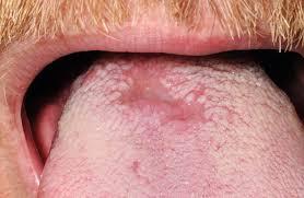 Image result for Primary Syphilis