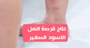 علاج قرصة النمل الاسود الصغير بطرق طبيعية