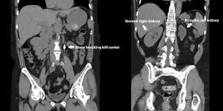 If Have A Kidney Stone Why Am I Getting A Ct Scan I Thought Kidney Stones Don T Show Up On Them Quora What is a kidney stone? ct scan i thought kidney stones
