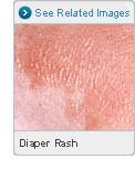 Image result for newborn diaper rash
