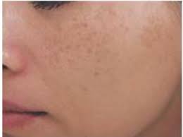 Image result for Diffuse Hyperpigmentation