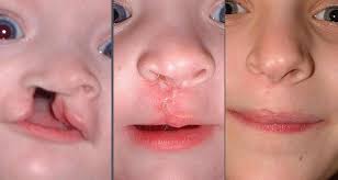 Explora 50 fotografías e imágenes de stock sobre paladar hendido o realiza una nueva búsqueda para encontrar más. El Labio Y Paladar Hendido Es Una Afeccion Que Se Presenta En 1 De Cada 750 Ninos Hospital San Jose De Queretaro