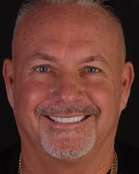 🌎 Hoy compartimos el testimonio de Colby Mosier, quien vino desde los EEUU  para transformar su sonrisa con nosotros. 🇺🇸✨ ¿Te gustaría mejorar tu  salud bucal y lucir una sonrisa radiante? 💬