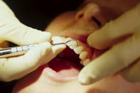 Is tarter removal possible at home? How To Remove Tartar From Teeth Call Today 855 614 5221 California Dental Group