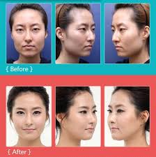 Pin By Alexey Kurilo On Asian Refs Korean Plastic Surgery Plastic Surgery Surgery