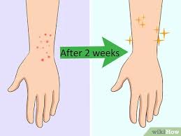 How do you get rid of noseeums. 3 Ways To Treat No See Um Bites Wikihow