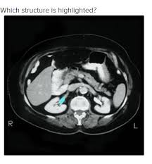 Minor and major renal calices, renal pelvis. Solved Multiple Choice Right Renal Pelvis Left Kidney Lef Chegg Com