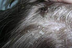 Tea Tree Oil For Dandruff Uses And Benefits Dandruff Treatment Oils For Dandruff Hair Remedies
