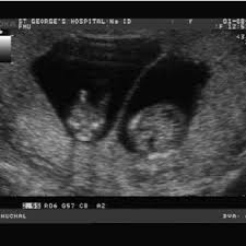 The dating scan can include a nuchal translucency (nt) scan, which is part of the combined screening test for down's syndrome , if you choose to have this screening. Ultrasound Showing The Leading Placental Edge Encroaching Into The Download Scientific Diagram