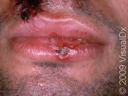 Image result for oral herpes symptoms roof of the mouth