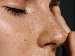 Image result for Freckled skin